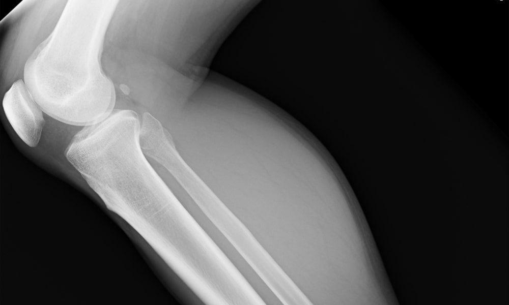 膝のレントゲン写真