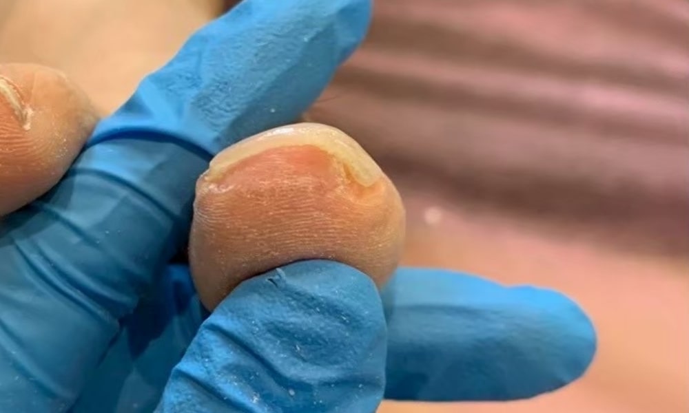 中度の巻き爪のアフター写真