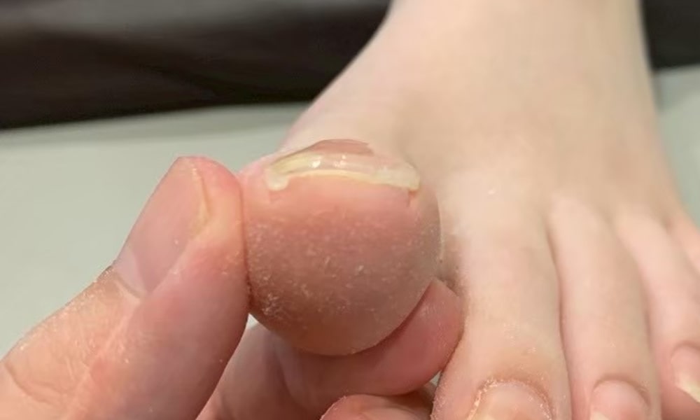 軽度の巻き爪のアフター写真