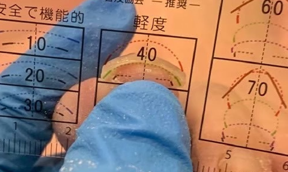 重度の巻き爪のアフター40度