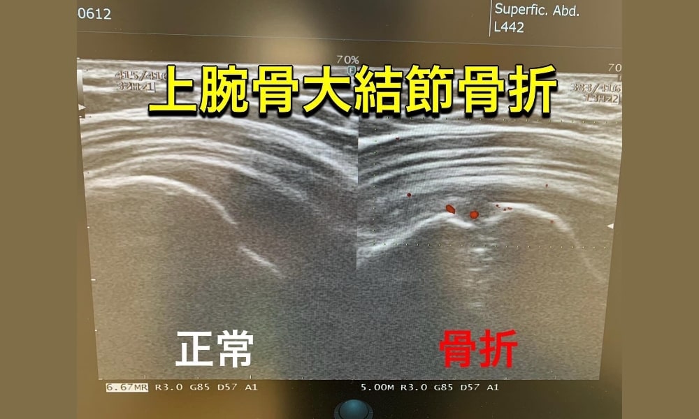 上腕骨大結節骨折の超音波エコー写真