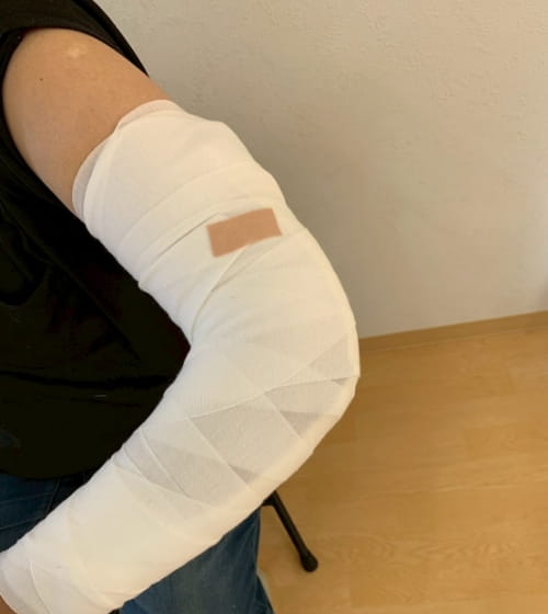 左肘の脱臼骨折の伊勢崎アシカ接骨院のシーネ固定