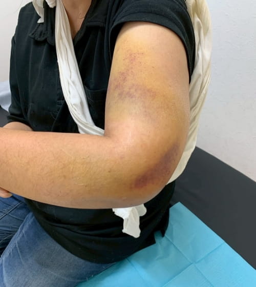 左肘の脱臼骨折の腫れの様子