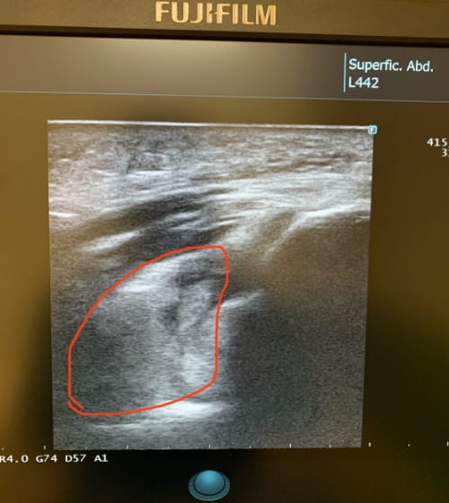 左肘の超音波エコー画像