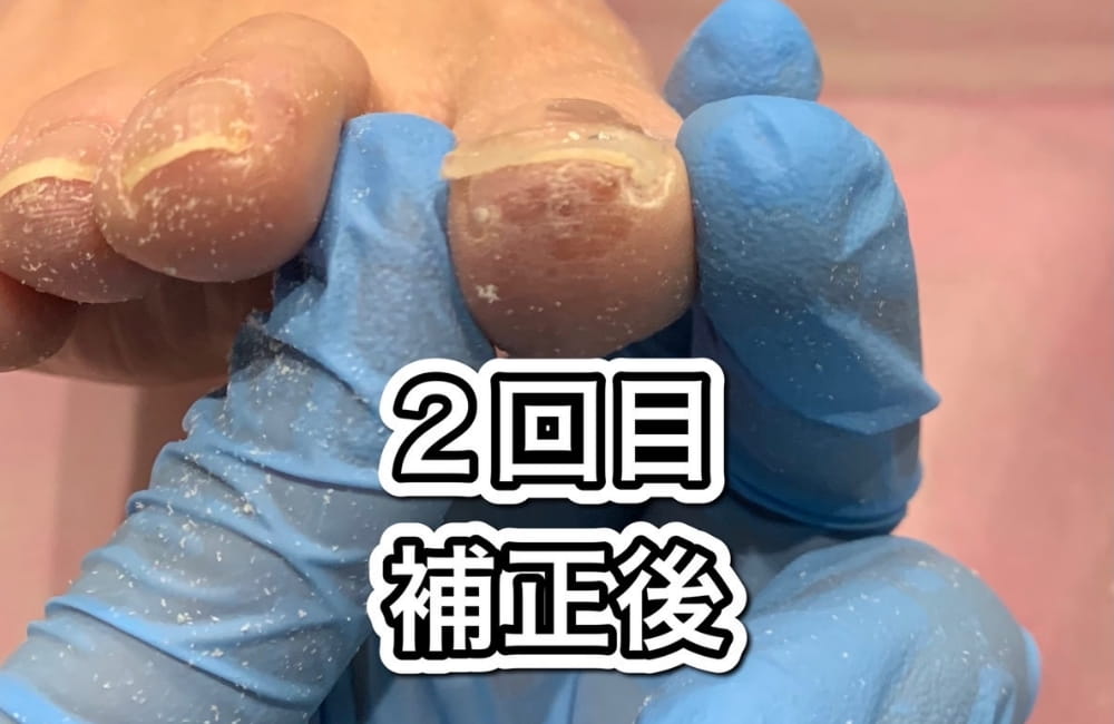 巻き爪矯正2回目