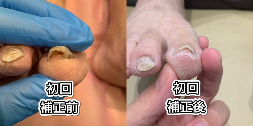 巻き爪補正の初回のビフォーアフター