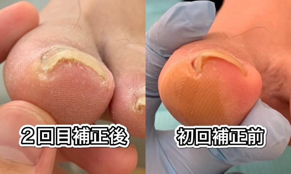 巻き爪のビフォーアフター画像