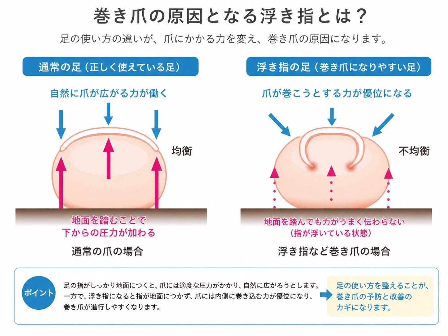 巻き爪の原因となる浮き指の原因