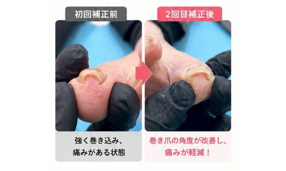 巻き爪矯正のビフォーアフター