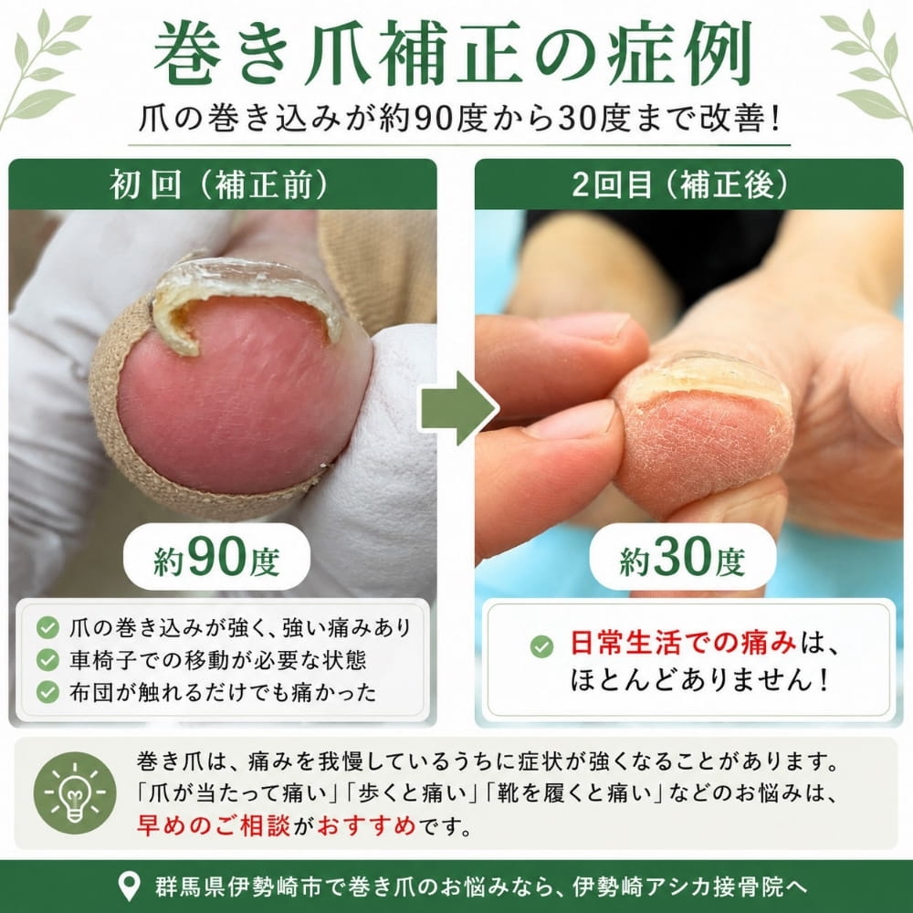 巻き爪矯正の症例報告画像